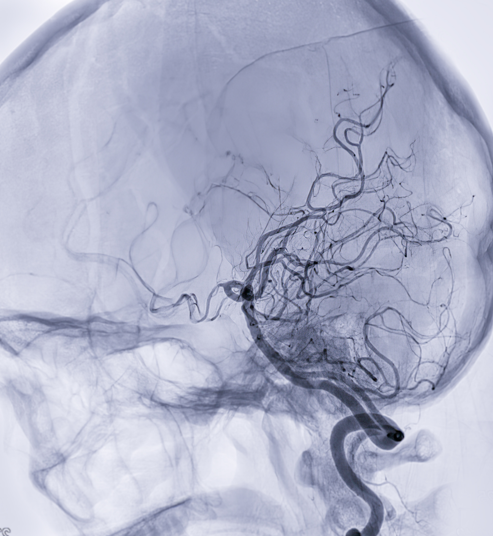 Are the brain's blood vessel pathways an early warning system for disease2.jpg