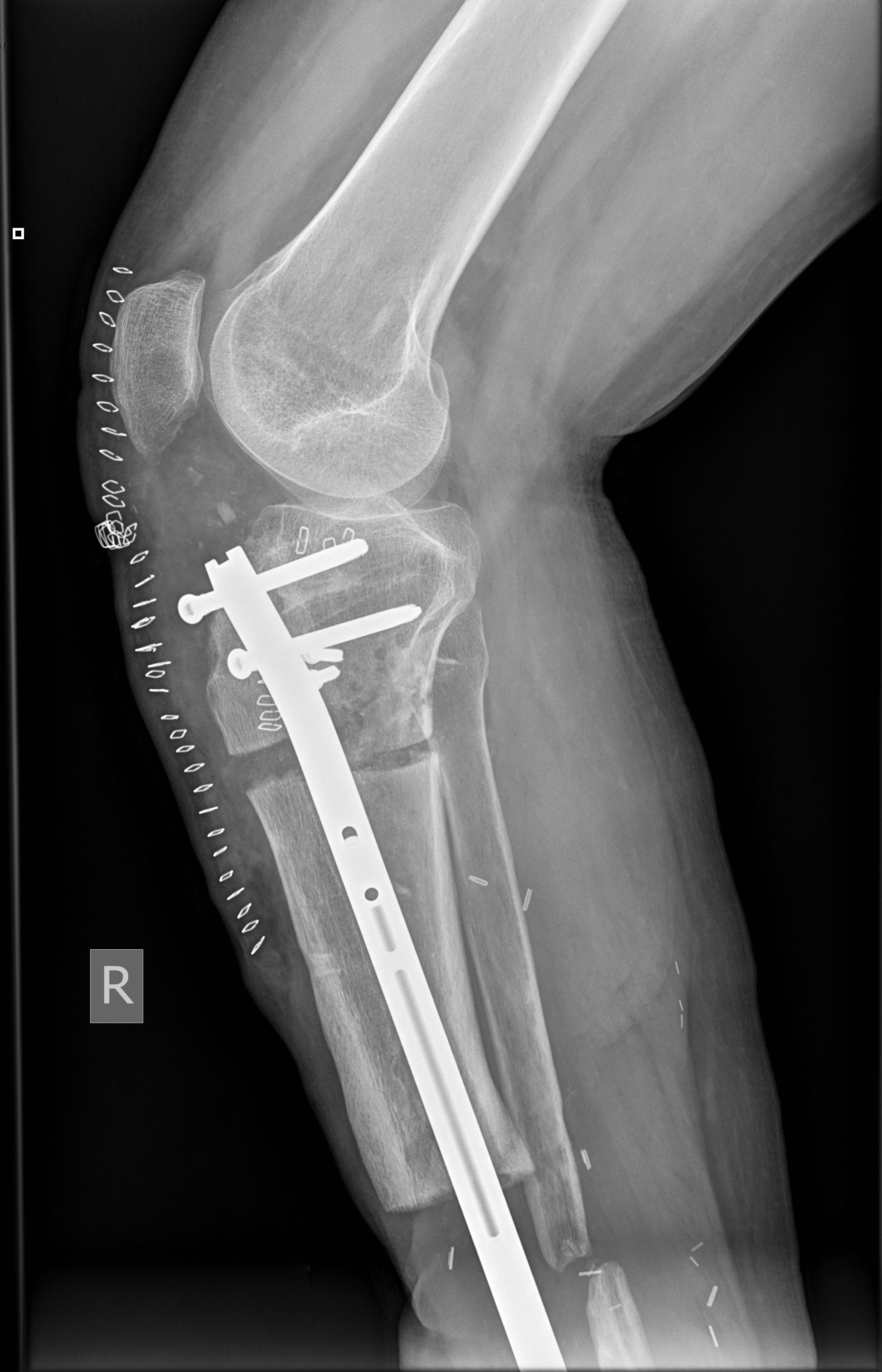 Bone surgery 2.jpg