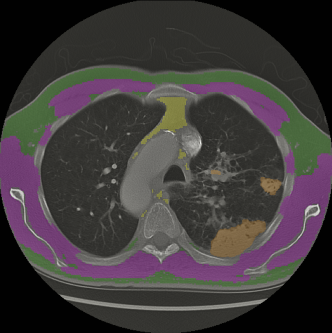 Using AI to Predict Cancer Outcomes2.png